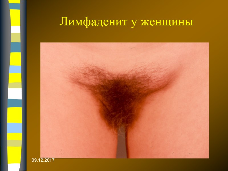 09.12.2017 Лимфаденит у женщины